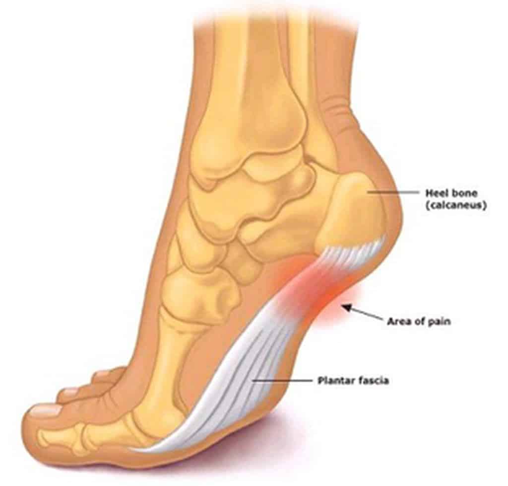 Does Plantar Fasciitis Hurt In The Ball Of The Foot At Joyce Brice Blog